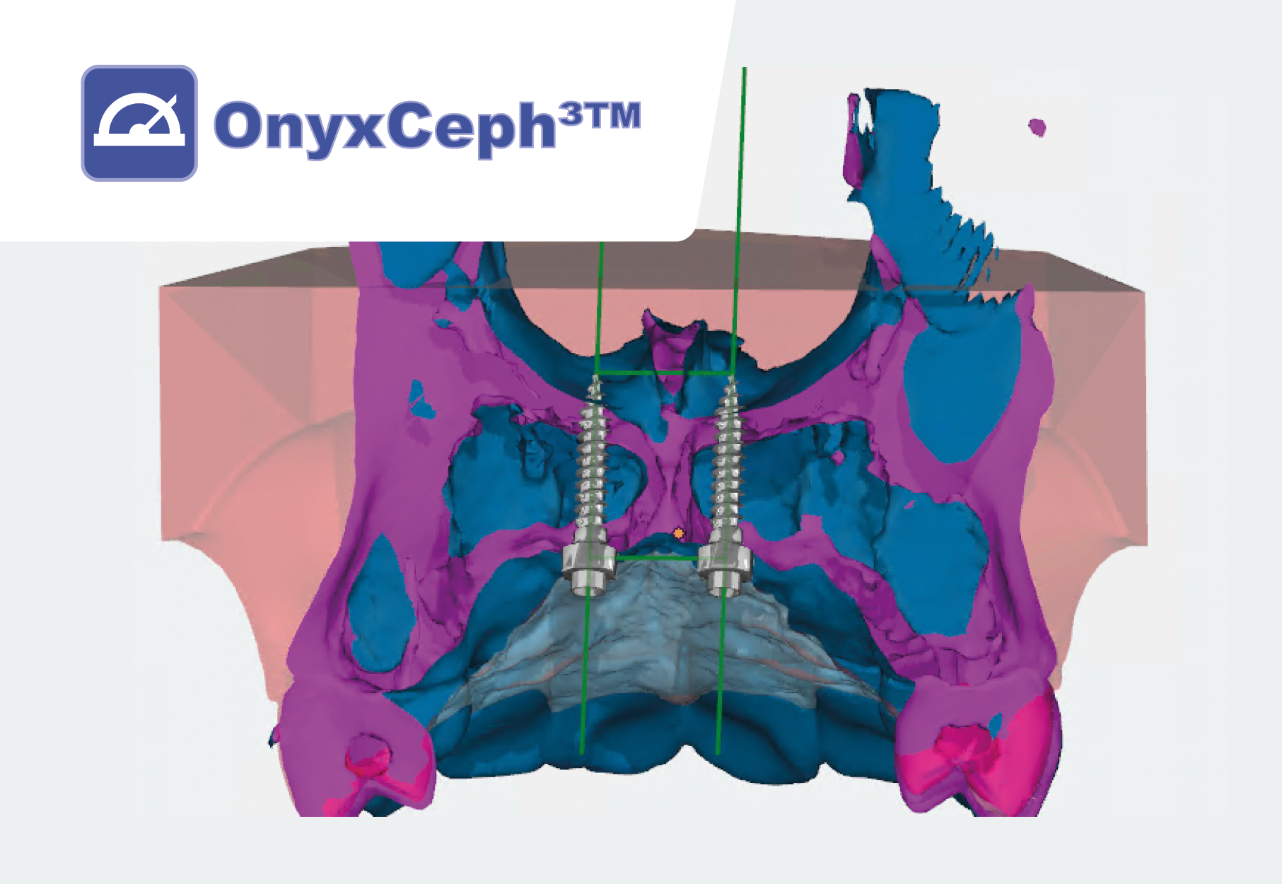 Onyxceph - szablony do mikroimplantów